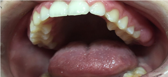 ¿Qué es el cáncer oral?