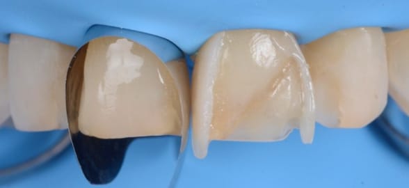 Carillas directas de composite dental: ventajas y desventajas frente a otro tipo de materiales