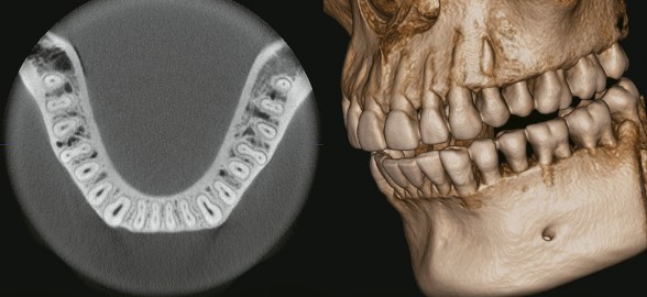 Tomografía computarizada de haz cónico (CBTC) ¿Qué es y para que se utiliza en odontología?