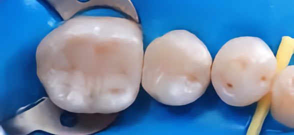 Cemento hidróxido de calcio: como actúa y sus usos en recubrimiento pulpar y endodoncia