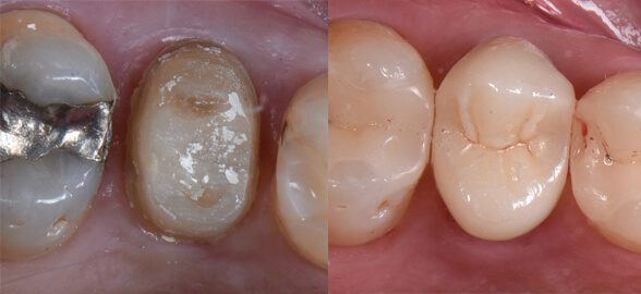 Caso clínico: RelyX Universal para todas las restauraciones posteriores