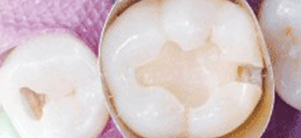 Todo lo que debes saber sobre cementos dentales (IV): Cemento Ionómero de vidrio