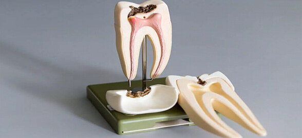 Cementos MTA: El material desarrollado para Endodoncia