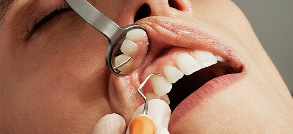 Conoce los cementos dentales Kerr Restoratives: Usos y Características