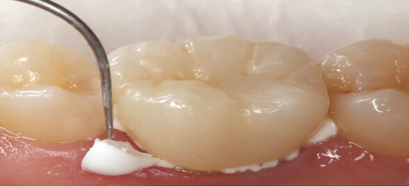  Guía de Cementado de Provisionales: Todo sobre Cementos Temporales