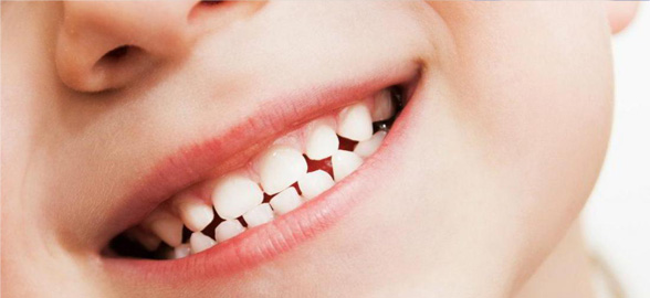 Colgate Duraphat: conoce cómo prevenir la caries y la sensibilidad dental