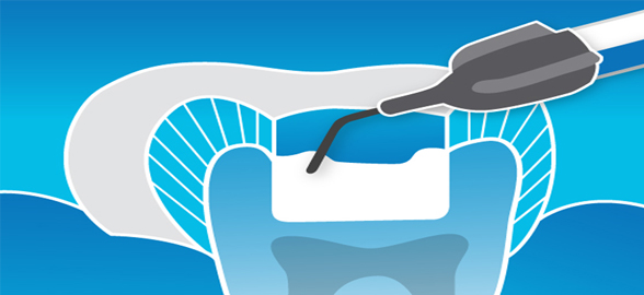 Filtek Supreme de 3M: Consejos para el éxito con los composites fluidos