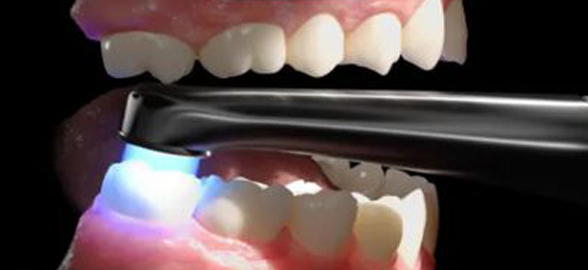 ¿Cómo elegir una lámpara de polimerización para la clínica dental?