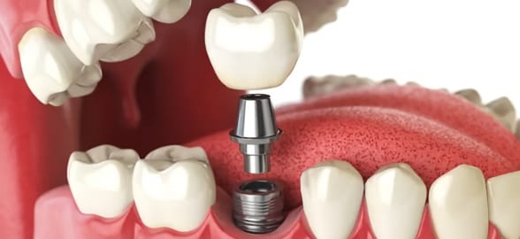 ¿Qué cuidados especiales deben tener los pacientes con implantes dentales?