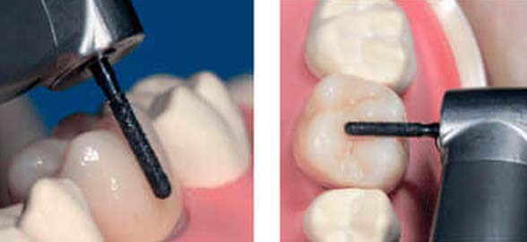 Fresas de diamante ZirconCut: ¿Por qué resultan la opción más elegida para trabajar restauraciones de zirconio?