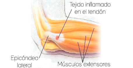 Epicondilitis o codo de tenista