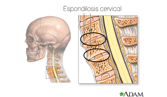 Espondilosis cervical