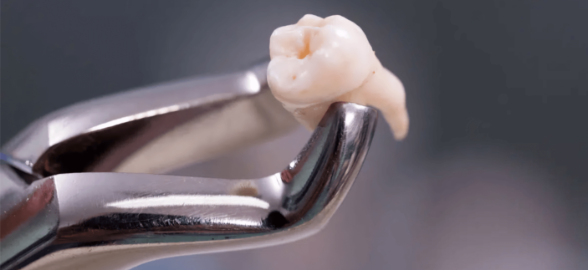 Los diferentes tipos de fórceps dentales y para qué sirven