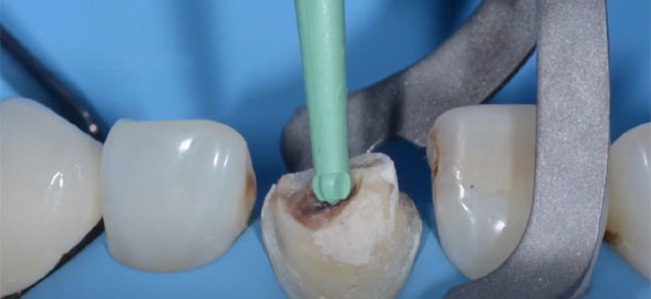 ¡Descubre las fresas dentales sin metal!