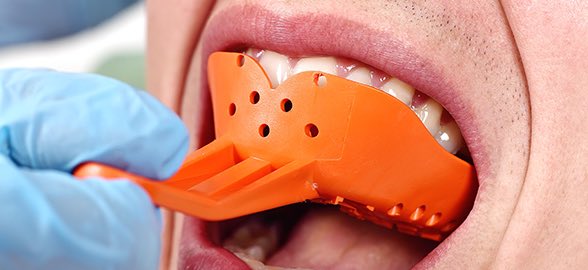 Guía de sostenibilidad: Prácticas sostenibles para la gestión de residuos de materiales de impresión dental y vaciado