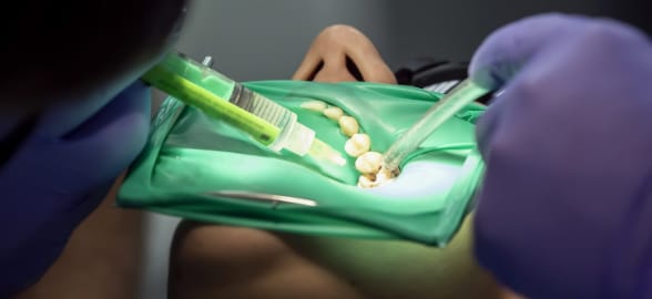 Aprende todo sobre las soluciones irrigantes en endodoncia: Una guía completa para profesionales dentales