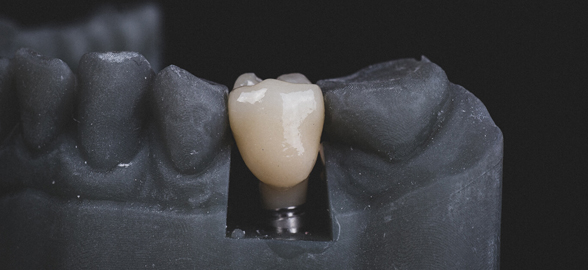 ¡Guía de implantes dentales con caso clínico!
