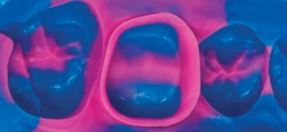 12 problemas que podemos corregir para lograr la impresión dental perfecta