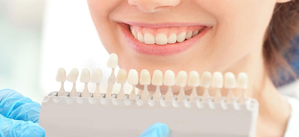 Guía Lineal Vita 3D-Master: Cómo usarla para encontrar el mejor composite dental