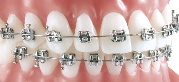Guía de producto KDM Orthodontics: Tipos, accesorios y características