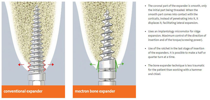 Mectron bone expander kit - Dentaltix