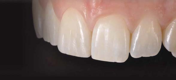 Composites Estético y Fluido de Kuraray: Características y usos