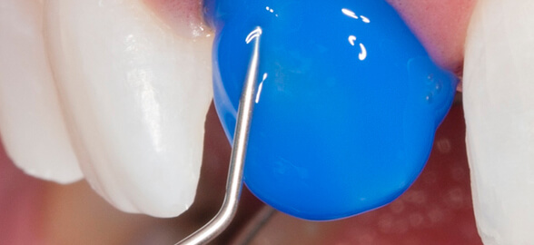 La guía más completa de ácidos grabadores dentales