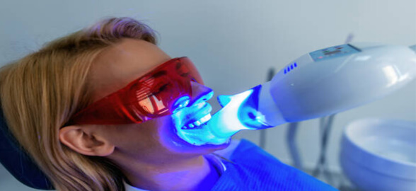 ¡Tu guía sobre la lámpara de blanqueamiento dental!