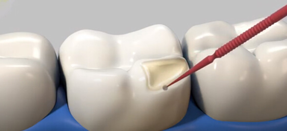 Los casos clínicos más sorprendentes de Kulzer: iBOND Universal