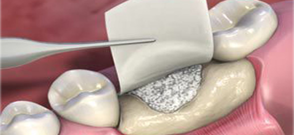 Membranas PTFE: Conoce sus características y usos.