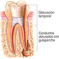 Obturador para endodoncias