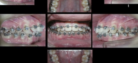 Curso online gratuito Ortodoncia: "Técnica de autoligado pasivo"