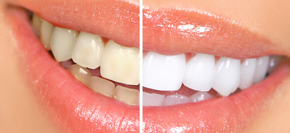 Guía Completa sobre Blanqueamiento Dental: Tipos, Procedimientos y Recomendaciones