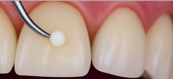 Composites Dentales: Guía Completa sobre Tipos, Usos, Beneficios y Aplicaciones en Odontología