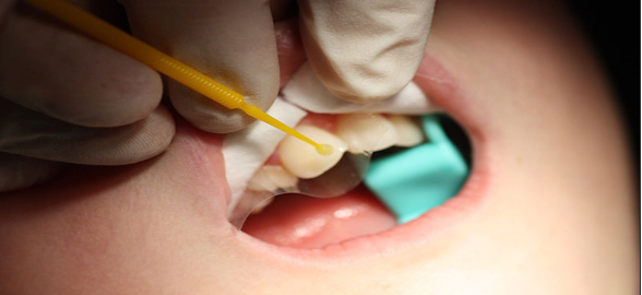 Adhesivos Dentales de Kuraray: características y tipos de productos 