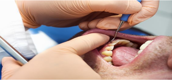 Lo último en tecnología de periodoncia: la sonda digital