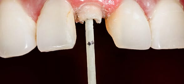 Todo lo que tienes que saber sobre los postes de fibra de vidrio y su cementación exitosa