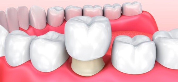 5 Preguntas de tus pacientes sobre puentes, coronas y carillas dentales