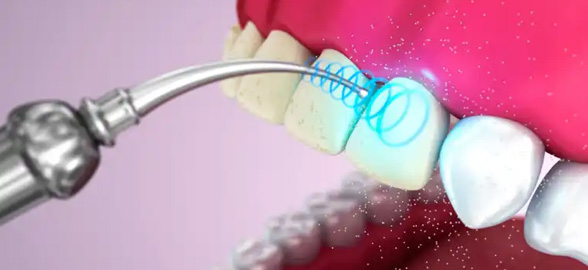 Guía completa sobre las puntas de ultrasonido: ¿Qué tipos existen y para qué sirven?