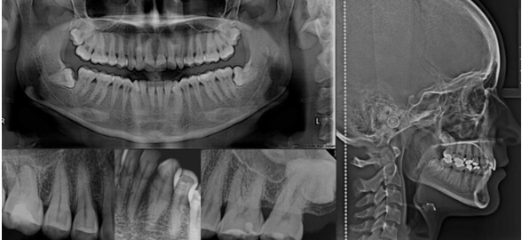 Guía Completa de las Radiografías Dentales