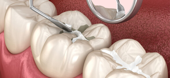 Guía completa sobre los selladores dentales: Prevención contra las caries