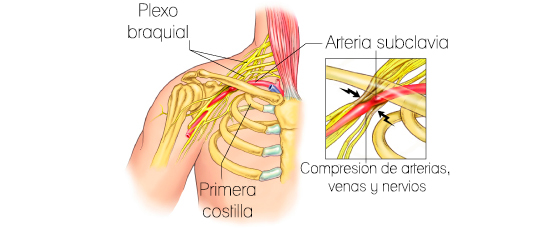 Sindrome de la salida toracica