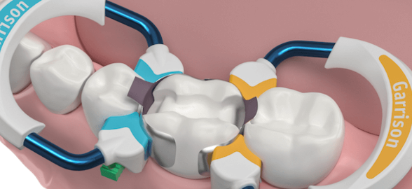 La guía definitiva sobre las matrices dentales: elige la mejor para cada caso