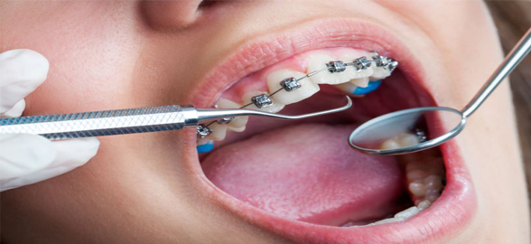 Técnicas de levante de mordida en tratamientos de Ortodoncia