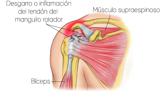 Tendinitis del manguito rotador