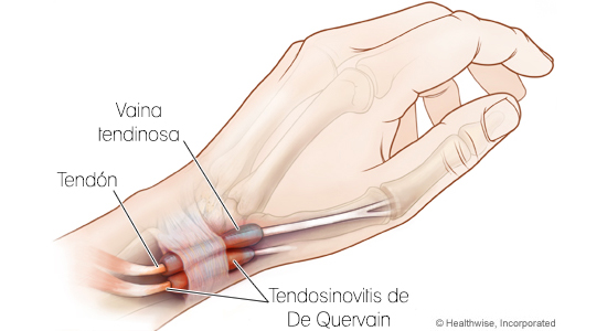 Tendosinovitis de DeQuervain