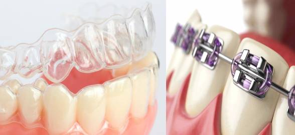 Tipos de tratamientos de ortodoncia existen en la actualidad ¿Cómo elegir el más apropiado?
