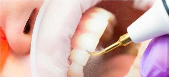 Todo lo que debes saber para elegir el aparato de ultrasonidos de tu clínica dental