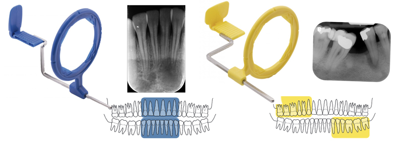 Radiografía periapical